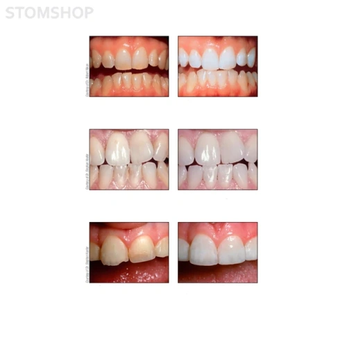 Opalescence PF 10% Doctor Kit Melon - набор принадлежностей для домашнего отбеливания зубов | Ultradent (США)