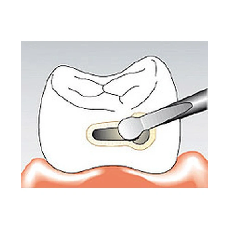 Sonicflex bevel №58 - насадка для минимально инвазивной терапии кариеса с алмазным покрытием, мезиальная | KaVo (Германия)