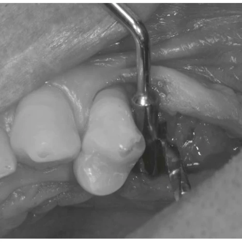 LM Implant Misura MR 3.1-5.3 - инструмент для позиционирования имплантатов | LM-Instruments Oy (Финляндия)