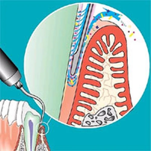 Sonicflex paro №62 - насадка с рабочим концом, изогнутым вправо с закругленной верхушкой для минимально инвазивной терапии пародонтита | KaVo (Германия)