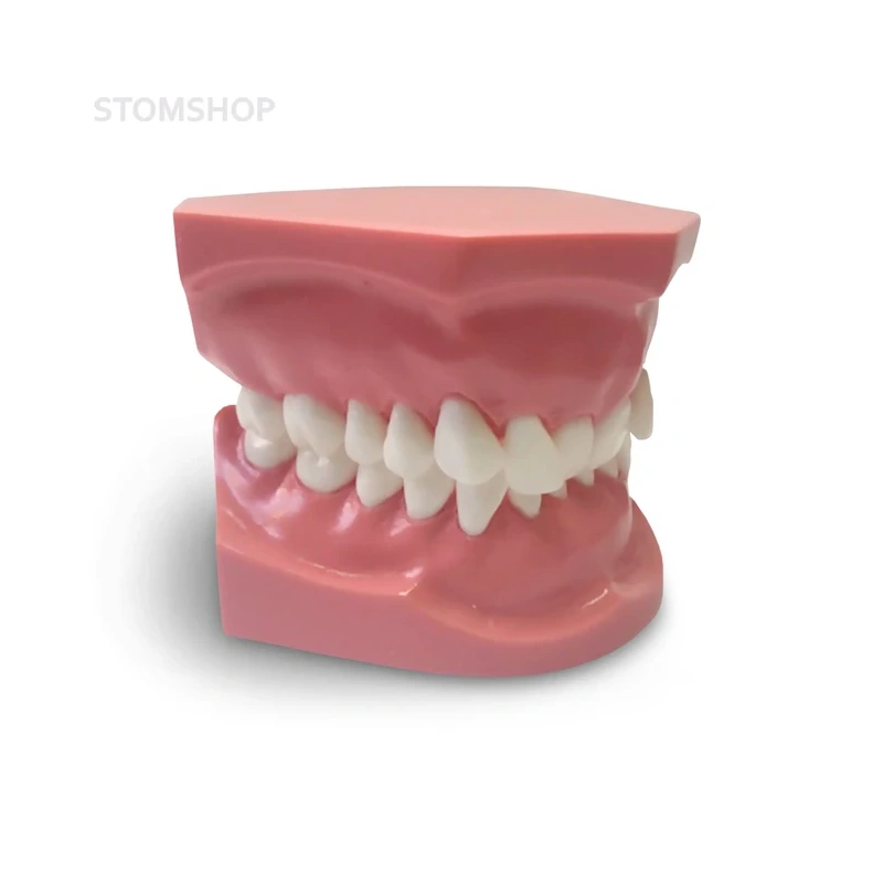 ORB06 – ортодонтическая модель с брекетами и твердой десной, 2 класс | GF Dental (Италия)