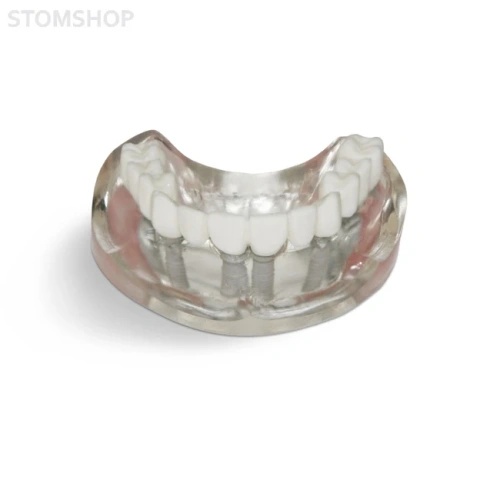 T10 – демонстрационная модель верхней челюсти с 6 имплантами и протезом | GF Dental (Италия)