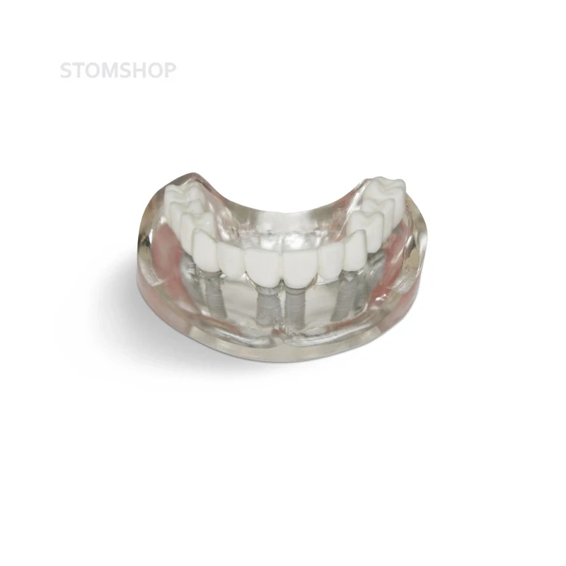 T10 – демонстрационная модель верхней челюсти с 6 имплантами и протезом | GF Dental (Италия)