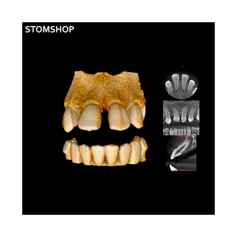 CS 8100 3D - дентальный трехмерный томограф, FOV 8х9 см | Carestream Dental (США)