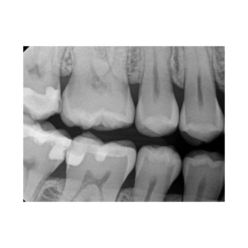 Kodak RVG 6200 - радиовизиограф, 24 пар линий/мм | Carestream Dental (США)