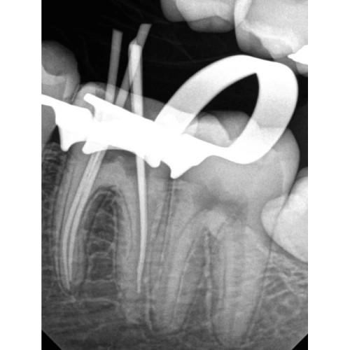 Kodak RVG 6200 - радиовизиограф, 24 пар линий/мм | Carestream Dental (США)