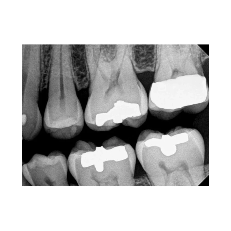 Kodak RVG 6200 - радиовизиограф, 24 пар линий/мм | Carestream Dental (США)