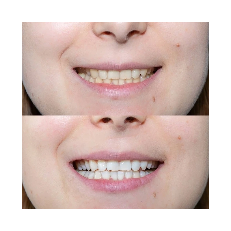 Amazing White Premium Teeth Whitening Kit 38% - набор для клинического отбеливания | Amazing White (США)
