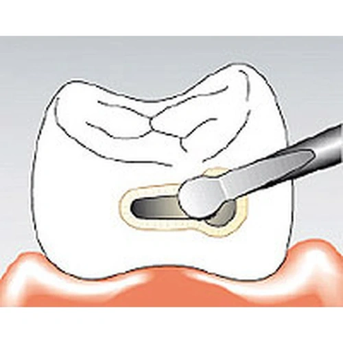 Sonicflex micro №33 - насадка для минимально инвазивной терапии кариеса с алмазным покрытием, большая полусфера, мезиальная | KaVo (Германия)