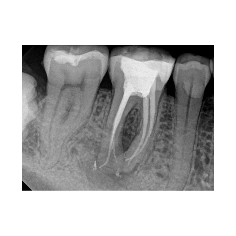 Kodak RVG 6200 - радиовизиограф, 24 пар линий/мм | Carestream Dental (США)