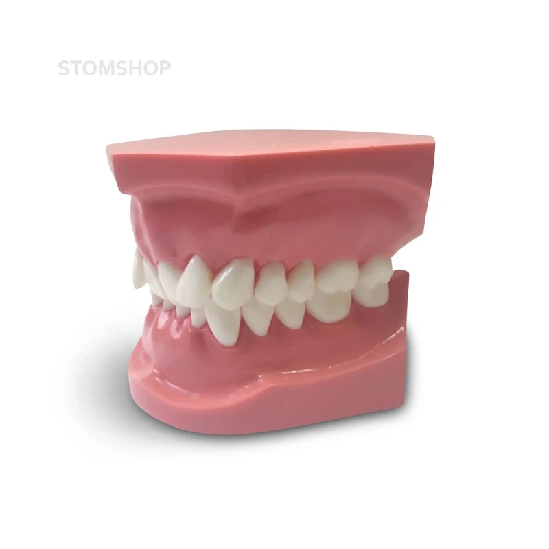 ORB06 – ортодонтическая модель с брекетами и твердой десной, 2 класс | GF Dental (Италия)